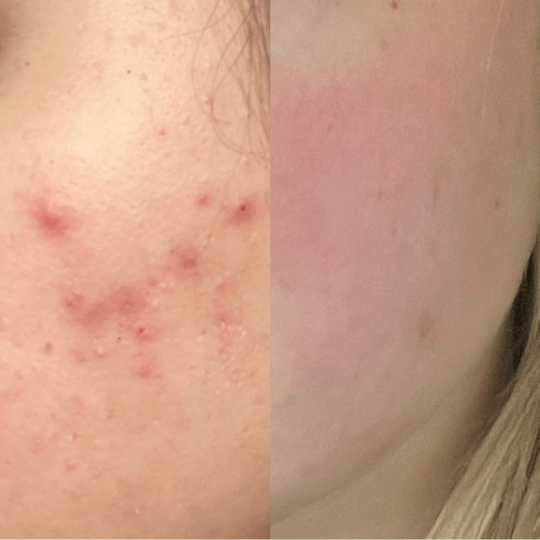 before and after image of acne after using reflekt skincare