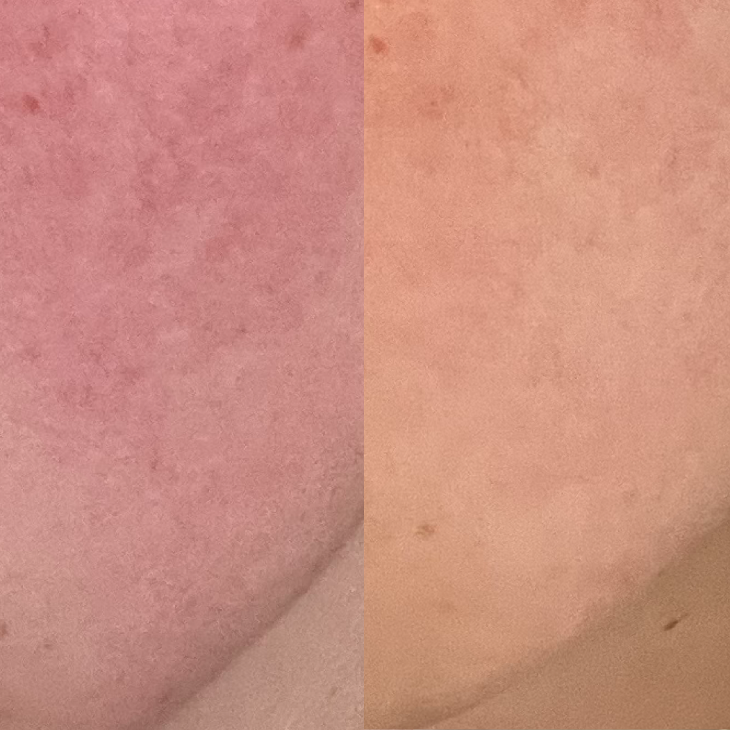 Before and after image showing reduction in blotchy, uneven skin tone