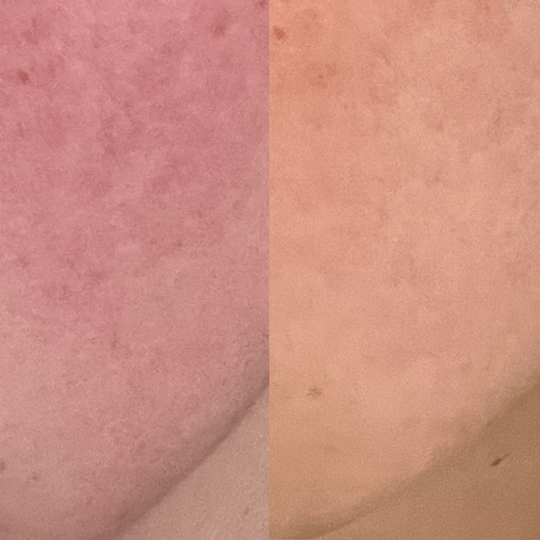 before and after image of the improvement of red and blotchy skin