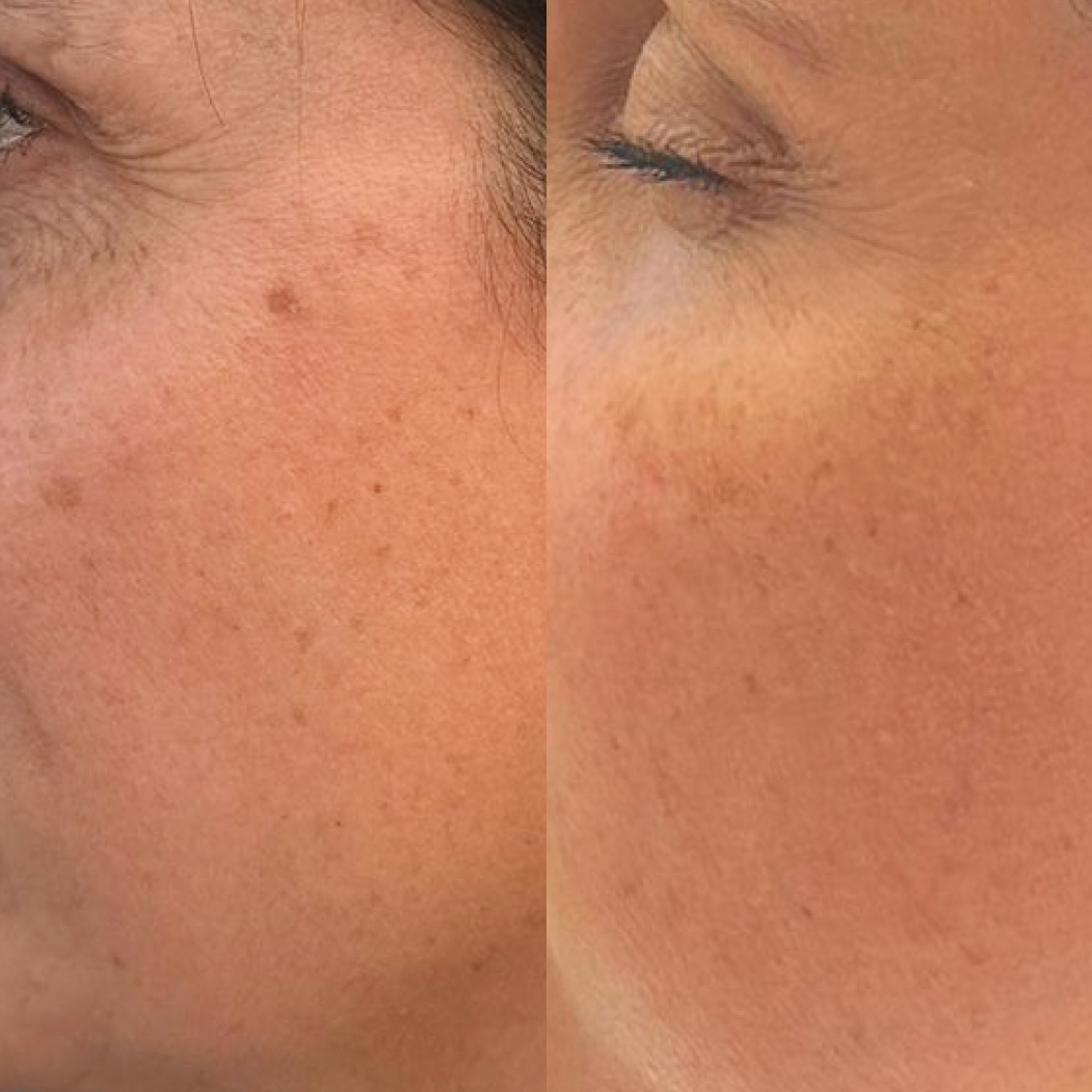 Before and after image showing plumper, more youthful-looking mature skin
