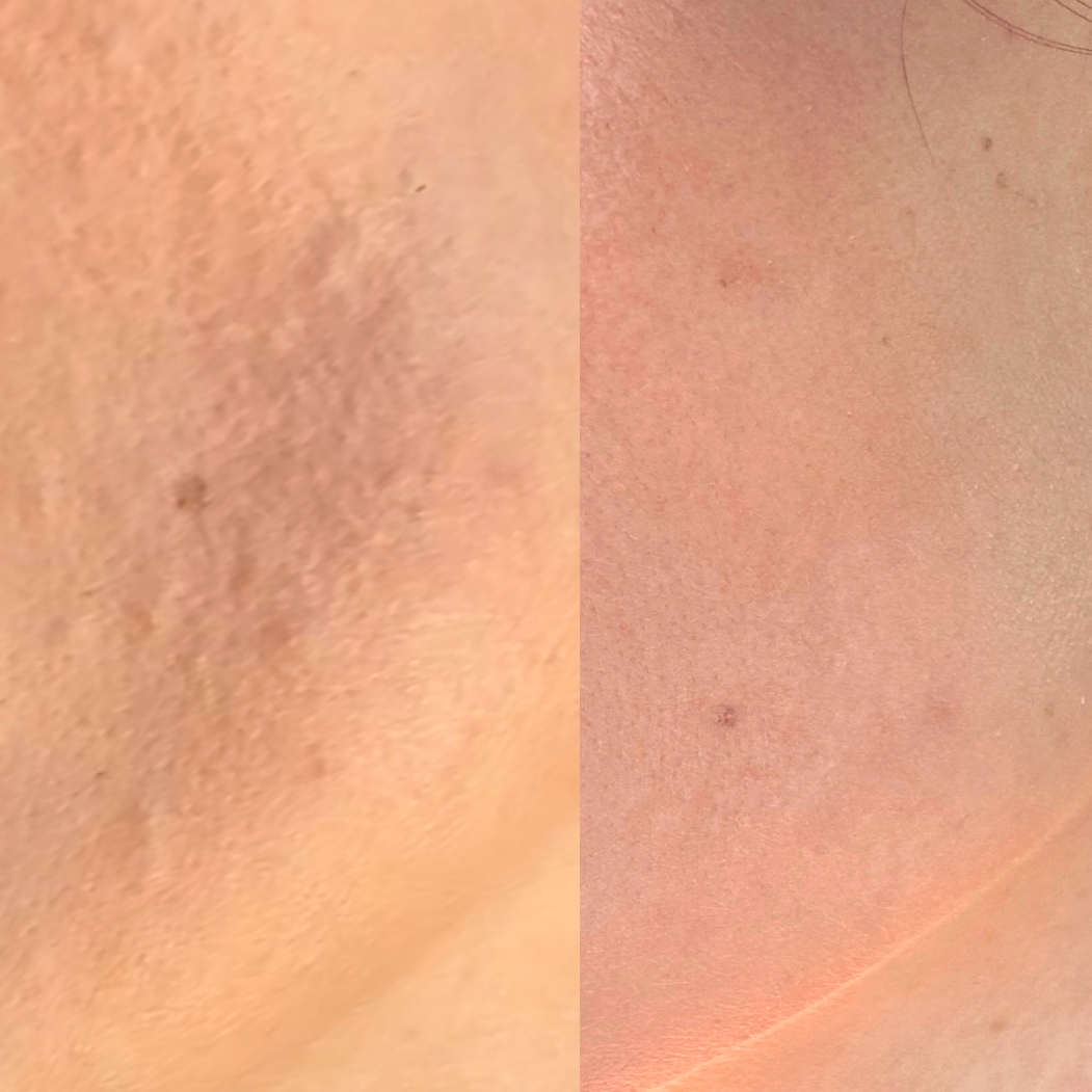Before and after image showing improvement in uneven skin texture and smoothness