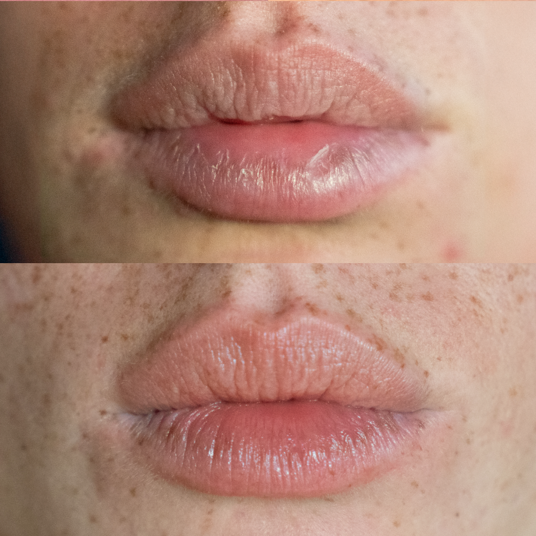 Lips before and after treatment with balm, showing reduction in dryness and enhanced plumpness