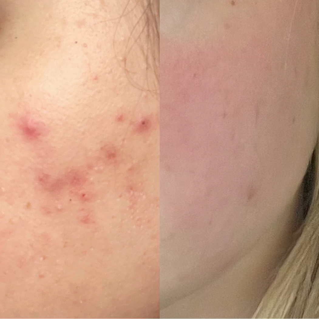 Before and after comparison of skin showing acne cleared