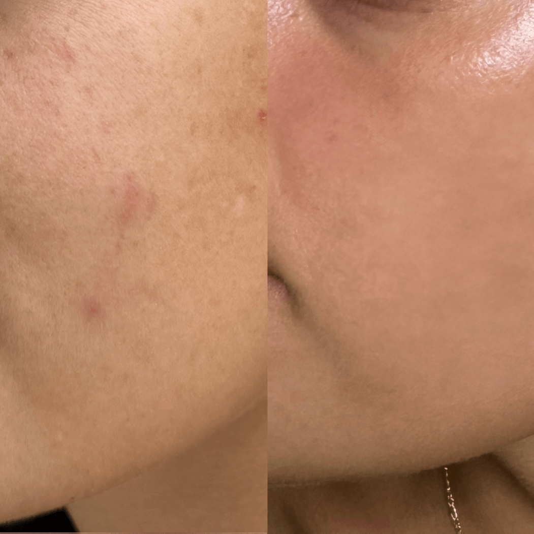 Before and after comparison of skin texture on a person's neck.