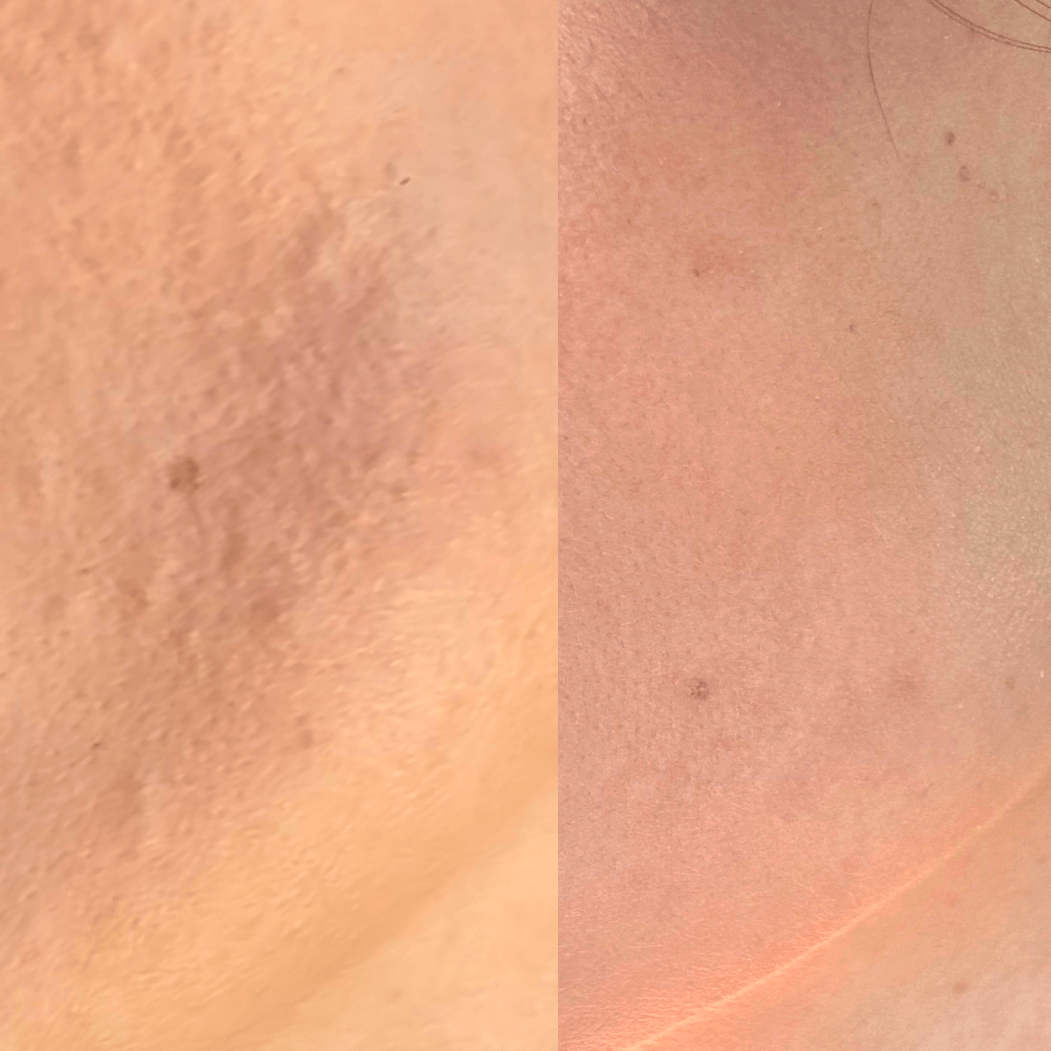 before and after image of textured skin showing the improvement