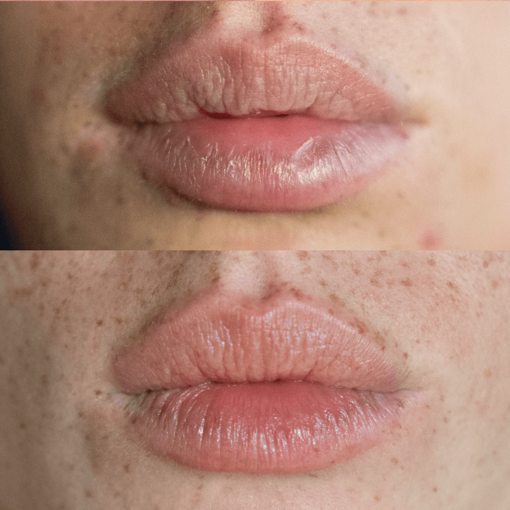 Before and after image of chapped lips using the lip balm. 